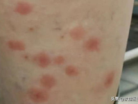 丘疹性荨麻疹症状,症状解析与防治要点